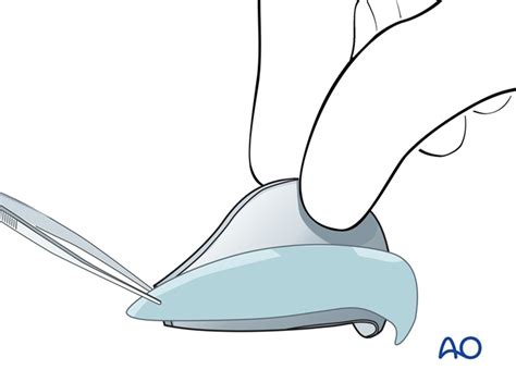 stage forehead flap  large partial thickness defect