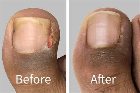 Ingrown Toenail Removal Recovery