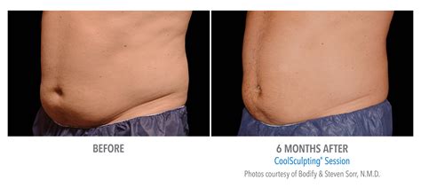 Fat Reduction Treatments - Aesthetic Center of New Jersey