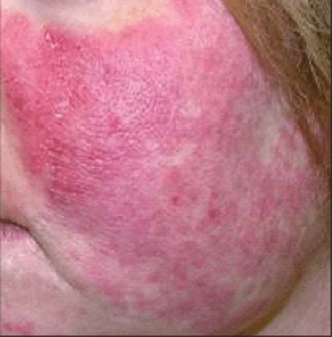 Acute cutaneous lupus erythematosus demonstrating the malar ...