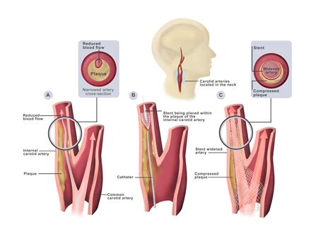 Carotid stenting - Dubai - Dr. Ahmed Farah