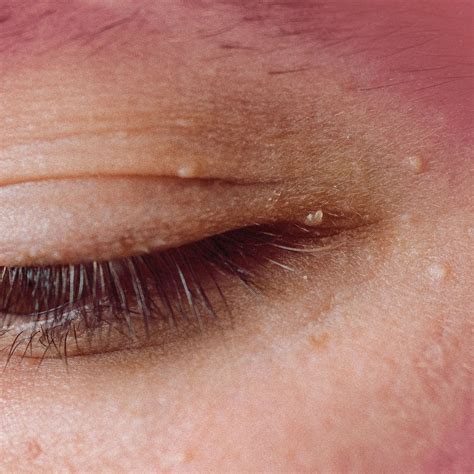 Eyelid White Spot What Is This White Speck On My Eye? It Isn't Moving