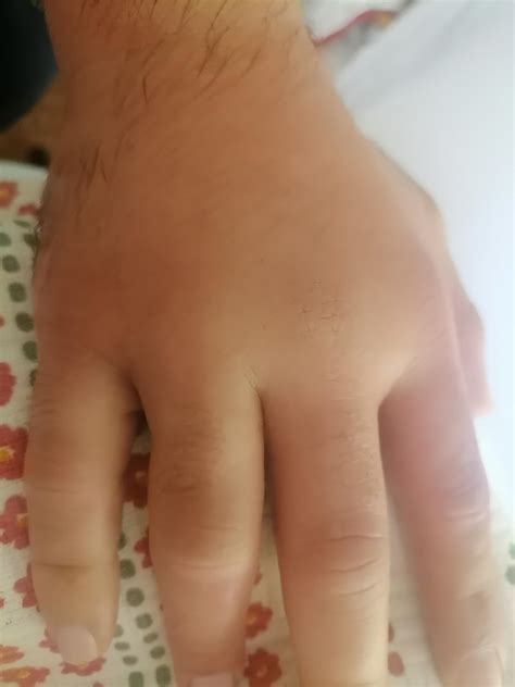 bee bite, is it so much swollen, far from hospital what can be done at