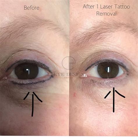 Remove Permanent Eyeliner: Benefits, Side Effects and Cost