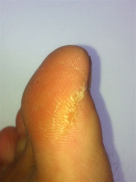 Corns & Callouses | Richmond Podiatry