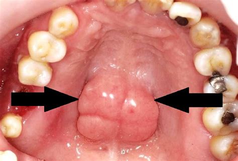torus palatinus  bony lump   roof   mouth oral health
