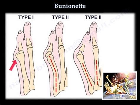 Bunionette - Everything You Need To Know - Dr. Nabil Ebraheim - YouTube