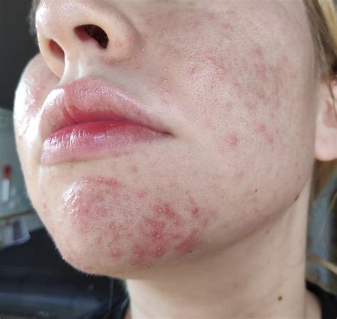 Acne pictures – Artofit