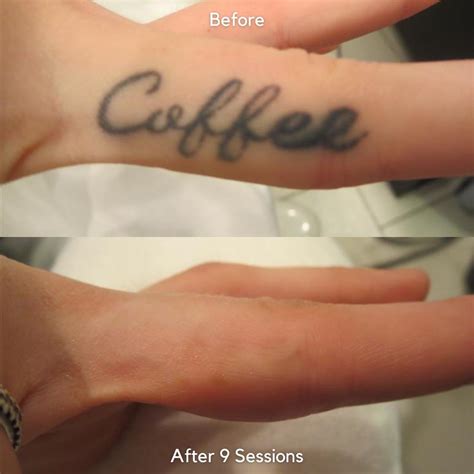 how much time between laser tattoo removal sessions - blackbearartdrawings