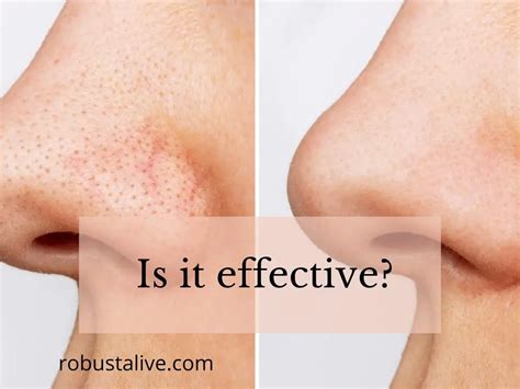 blackhead removal  accutane   effective