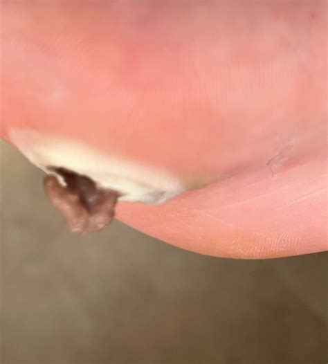 10+ year plantar wart healing journey! : r/Warts