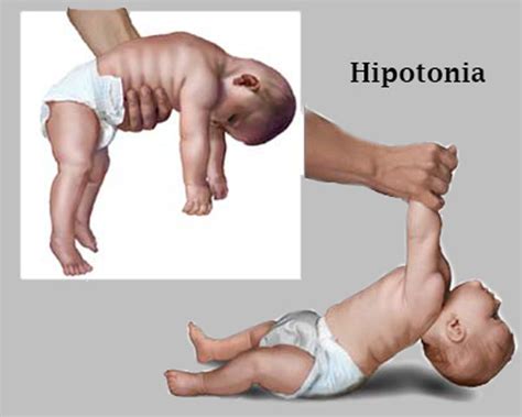O Que É Hipotonia Muscular - Hipotonia - O que é? Causas, Sinais, Sintomas, Tratamento, Diagnostico!
