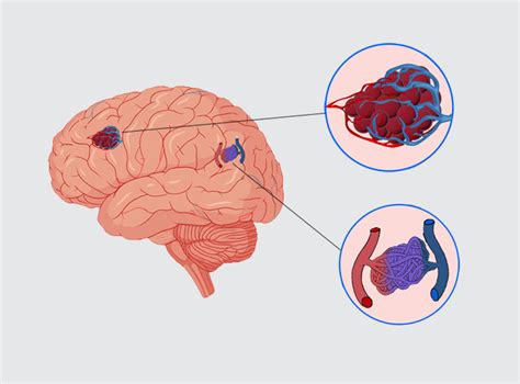 brain vascular malformation types   treatments