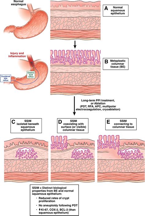 Subsquamous Intestinal Metaplasia: Implications for Endoscopic