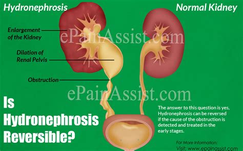 hydronephrosis reversible