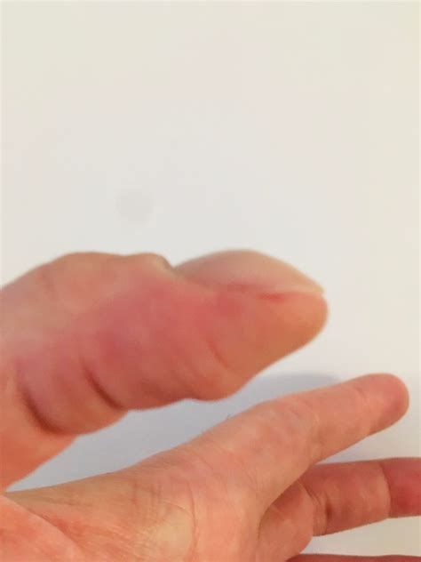 Nail Clubbing??? [PLEASE I need a Doc's opinion] : r/medical_advice