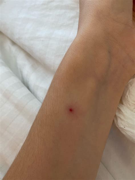 What kind of bug bite is this? Pls help : r/bugbites