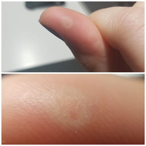 Feeling frustrated. Am I doing this right? (Freezeaway) : r/Warts