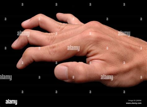 Ehlers Danlos And Marfan Syndrome Ehlers Danlos Aware - vrogue.co