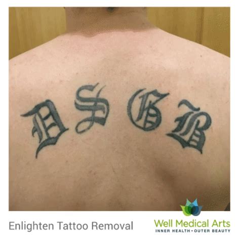 Tattoo Removal Gallery – Well Medical Arts: West Seattle's Medispa