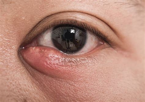 Duct Obstruction Aggravates MG Loss in Postmenopausal Women