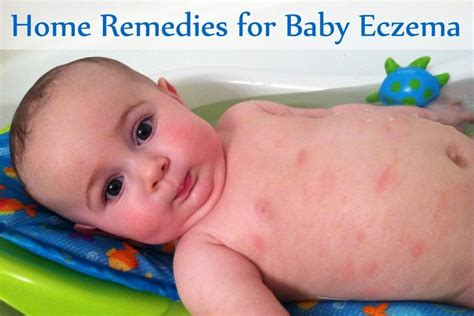 Baby Eczema: Best 13 Remedies For Baby