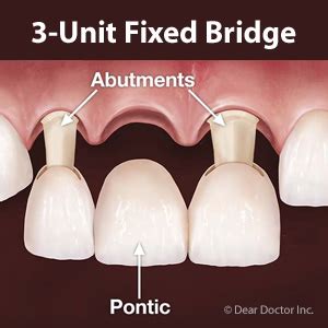 A Traditional Bridge Might be the Right Solution for Your Missing Teeth
