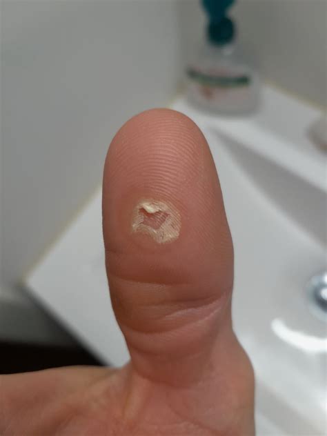 se  pelan los dedos de las manos de forma estacional