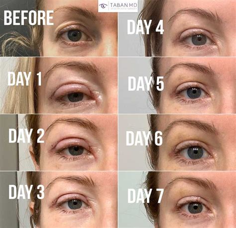 dr darm eyes blepharoplasty    pictures artofit
