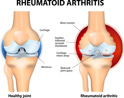 Rheumatoid Arthritis Diagnosis and Treatment: Drugs, Side Effects