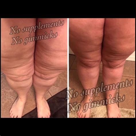 Resilience and the Carnivore Diet: Defying Lipedema