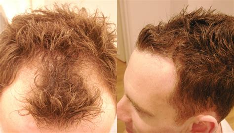 receding hairline international hair studio