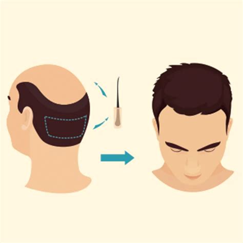 Follicular Unit Extraction - FUE Hair transplant: DNCC