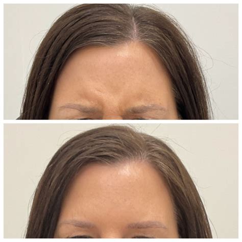 Crow's feet Botox in South Windsor | IV Lounge CT