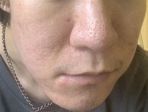 Phenol Peel? Scar pics - Scar treatments - Acne.org