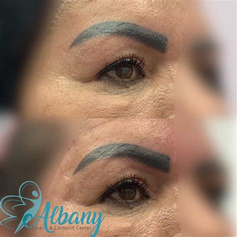 Eyebrow Lift: Case No.1110 Albany Cosmetic and Laser Centre In Edmonton