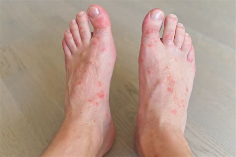 Diabetic Foot Ulcers: Causes, Symptoms and Care