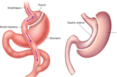 What is the difference between gastric sleeve and bypass?