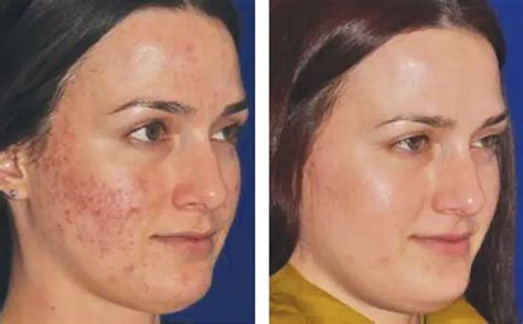 how long does it take to recover from microneedling