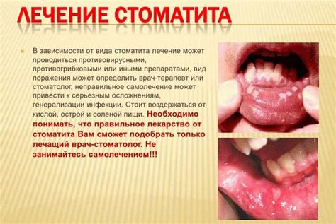 Симптомы (признаки) стоматита, как лечить стоматит