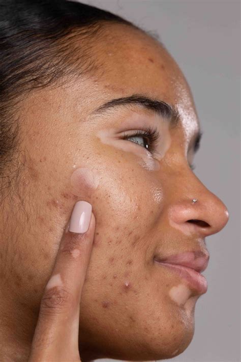 Do Pimple Patches Really Work? Here's Everything You Need To Know About