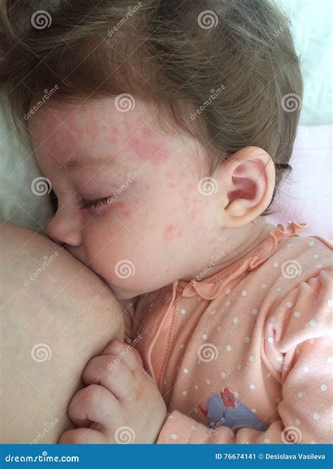 Roseola infantum stock image. Image of baby, point, subitum - 76674141
