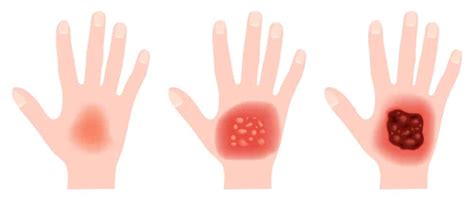 alles  brandwonden fonkelzorg verbonden met huisartsen