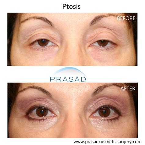Ptosis Surgery: Before and After, Types, Cost, Risks, Recovery