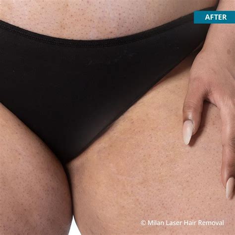 Bikini Before & After Photos of Laser Hair Removal | Milan Laser