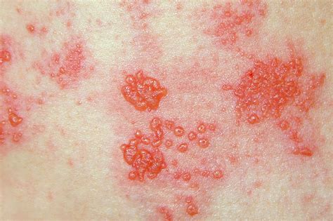long   shingles virus   fabric  theresa hanson blog