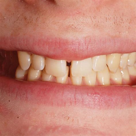 overbite  underbite treatment face teeth smile gerrards cross
