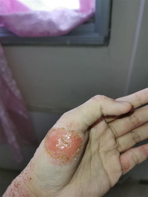 My hands has been like this for the past 2months it is "raw" and oozing
