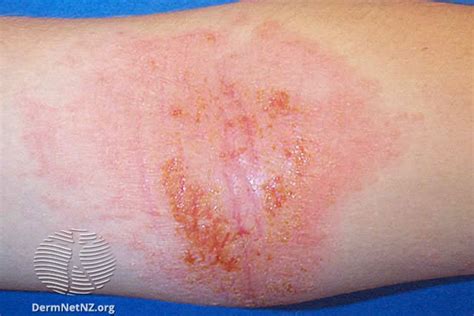 Dyshidrotic Eczema Elbow