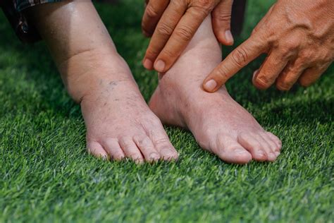 Signs and Symptoms of Poor Circulation in Feet - Palmetto State Podiatry
